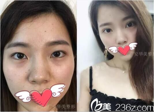 <!--<i data=20240703-sp></i>-->華美無痕雙眼皮術(shù)前術(shù)后對比照片 <!--<i data=20240703-sp></i>-->華美無痕雙眼皮術(shù)前術(shù)后對比照片