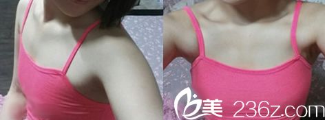 我在桂林時(shí)光整形做隆胸前的照片 我在桂林時(shí)光整形做隆胸前的照片