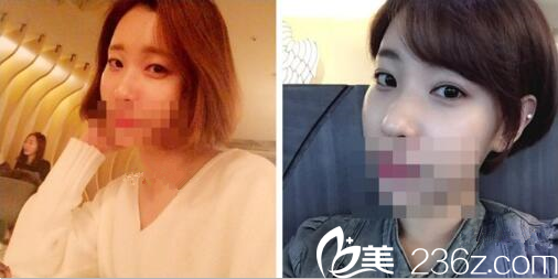 韓國(guó)迪美THE M做雙眼皮挺好的