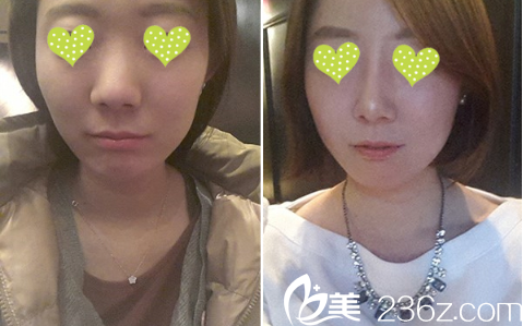 韓國(guó)迪美隆鼻挺好的