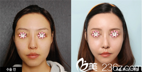 韓國(guó)迪美面部埋線提升真人實(shí)例圖好看