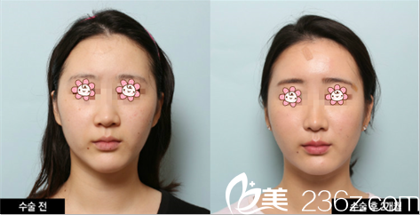 韓國(guó)迪美自體脂肪面部填充改善自然