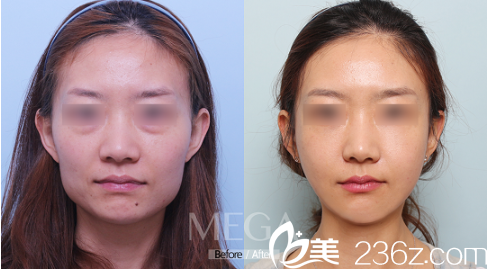 韓國(guó)迪美做下頜角手術(shù)好