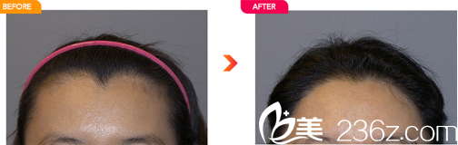 韓國(guó)迪美發(fā)際線種植實(shí)例圖