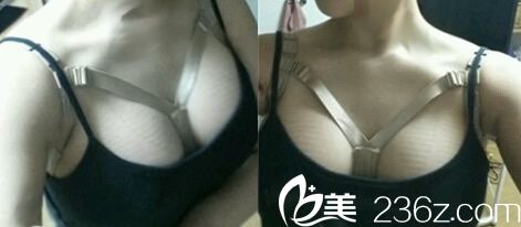 我在時(shí)光整形做曼托假體隆胸術(shù)后第10天 我在時(shí)光整形做曼托假體隆胸術(shù)后第10天