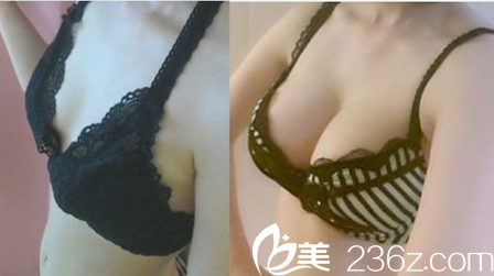 韓國迪美整形吳柱鉉假體豐胸案例 韓國迪美整形吳柱鉉假體豐胸案例