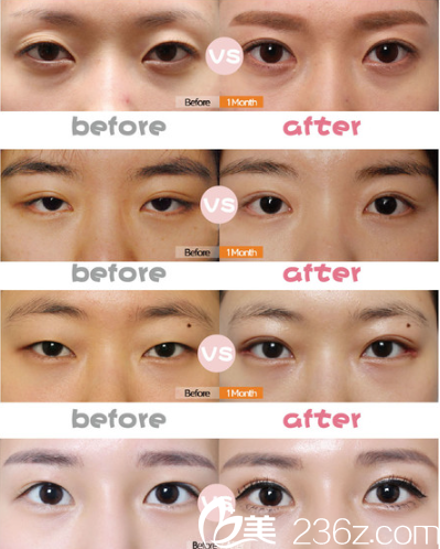 韓國迪美整形做雙眼皮怎么樣 韓國迪美整形做雙眼皮怎么樣