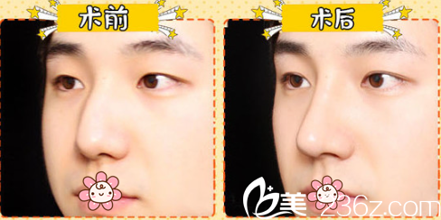 韓國迪美整形李柱洪鼻綜合案例 韓國迪美整形李柱洪鼻綜合案例