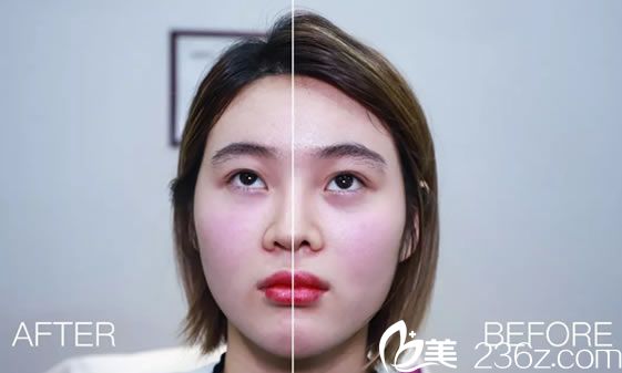 注射膠原蛋白祛黑眼圈案例效果