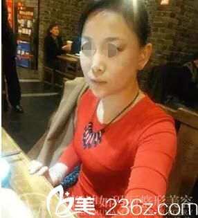 無錫坤如瑪麗真人術前術后對比照分享：為什么豐下巴不選硅膠或膨體材料，而選擇艾莉薇玻尿酸注射