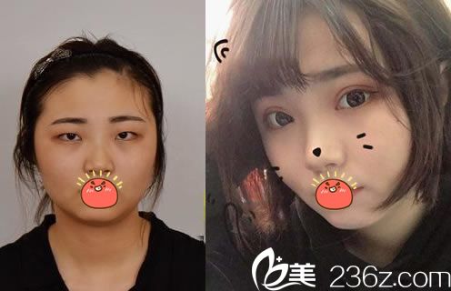 嘉興禾美整形雙眼皮案例