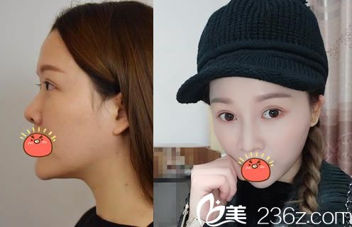 嘉興禾美整形醫(yī)院鼻綜合案例