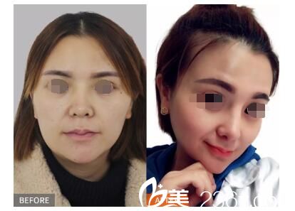 美貝爾“耳軟骨隆鼻精細縫合器”案例展示