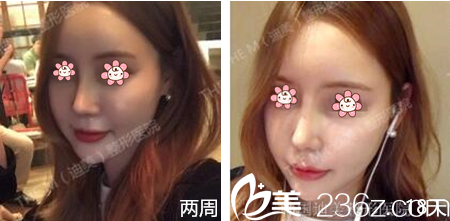 我在韓國(guó)留學(xué)，實(shí)地考察了兩個(gè)月較后去了韓國(guó)迪美(THE M)整形李柱洪那兒做的鼻綜合。