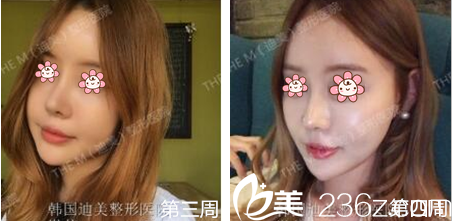 李柱洪鼻綜合一個月左右 李柱洪鼻綜合一個月左右