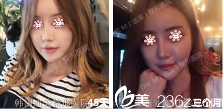韓國迪美(THE M)整形鼻綜合三個月 韓國迪美(THE M)整形鼻綜合三個月