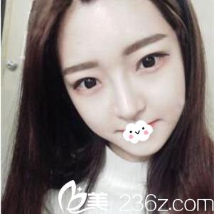 我就是找武漢涵美醫(yī)療美容做硅膠假體隆鼻綜合整形后顏值提升了