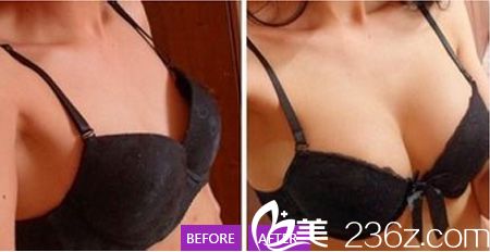 京美整形醫(yī)院隆胸案例