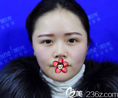 在義烏陽光醫(yī)院做隆鼻手術(shù)前 在義烏陽光醫(yī)院做隆鼻手術(shù)前