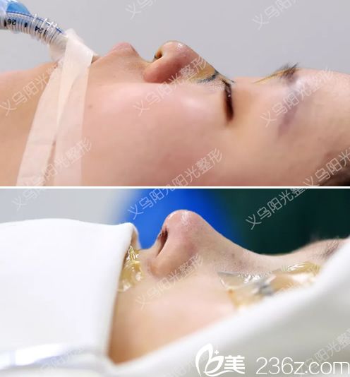 義烏陽光整形醫(yī)院隆鼻<span style= 義烏陽光整形醫(yī)院隆鼻<span style=