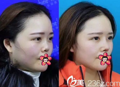 義烏陽光整形隆鼻<span style= 義烏陽光整形隆鼻<span style=