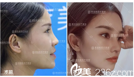 深圳美加美隆鼻案例前后對(duì)比圖 深圳美加美隆鼻案例前后對(duì)比圖