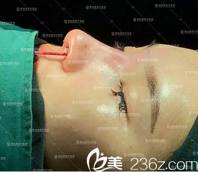 深圳么佳美肋軟骨隆鼻修復(fù)術(shù)后即刻效果圖 深圳么佳美肋軟骨隆鼻修復(fù)術(shù)后即刻效果圖