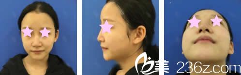 我在南寧美麗星整形做鼻綜合前的照片 我在南寧美麗星整形做鼻綜合前的照片