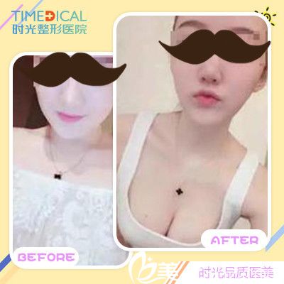 時光整形醫(yī)院朱云隆胸變化圖