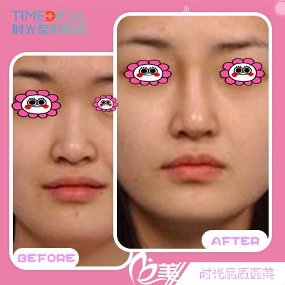 蘭州時光整形羅梅隆鼻前后對比圖