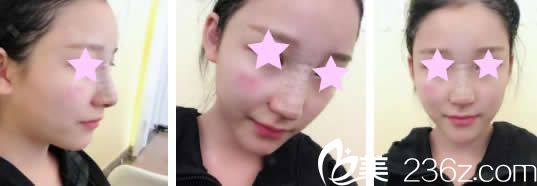 南寧美麗星李武斌給我做鼻綜合術(shù)后第3天照片 南寧美麗星李武斌給我做鼻綜合術(shù)后第3天照片