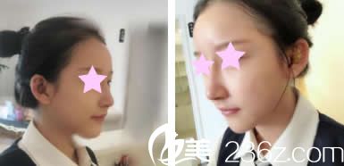 我找美麗星李武斌院長隆鼻術(shù)后第5天照片 我找美麗星李武斌院長隆鼻術(shù)后第5天照片