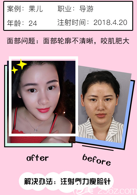 整形醫(yī)院瘦臉案例