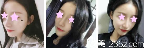 聽說南寧芯玥整形很靠譜就找李武斌做了膨體+軟骨鼻綜合，曬曬術(shù)后1-7天的照片