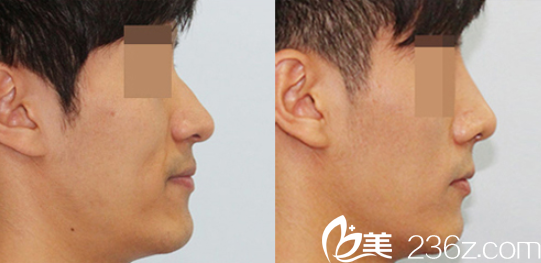 韓國(guó)定佑美容整形駝峰鼻矯正案例圖 韓國(guó)定佑美容整形駝峰鼻矯正案例圖