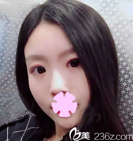 面部吸脂多久消腫？我在南寧愛(ài)思特整形做全臉吸脂10天就看到效果啦