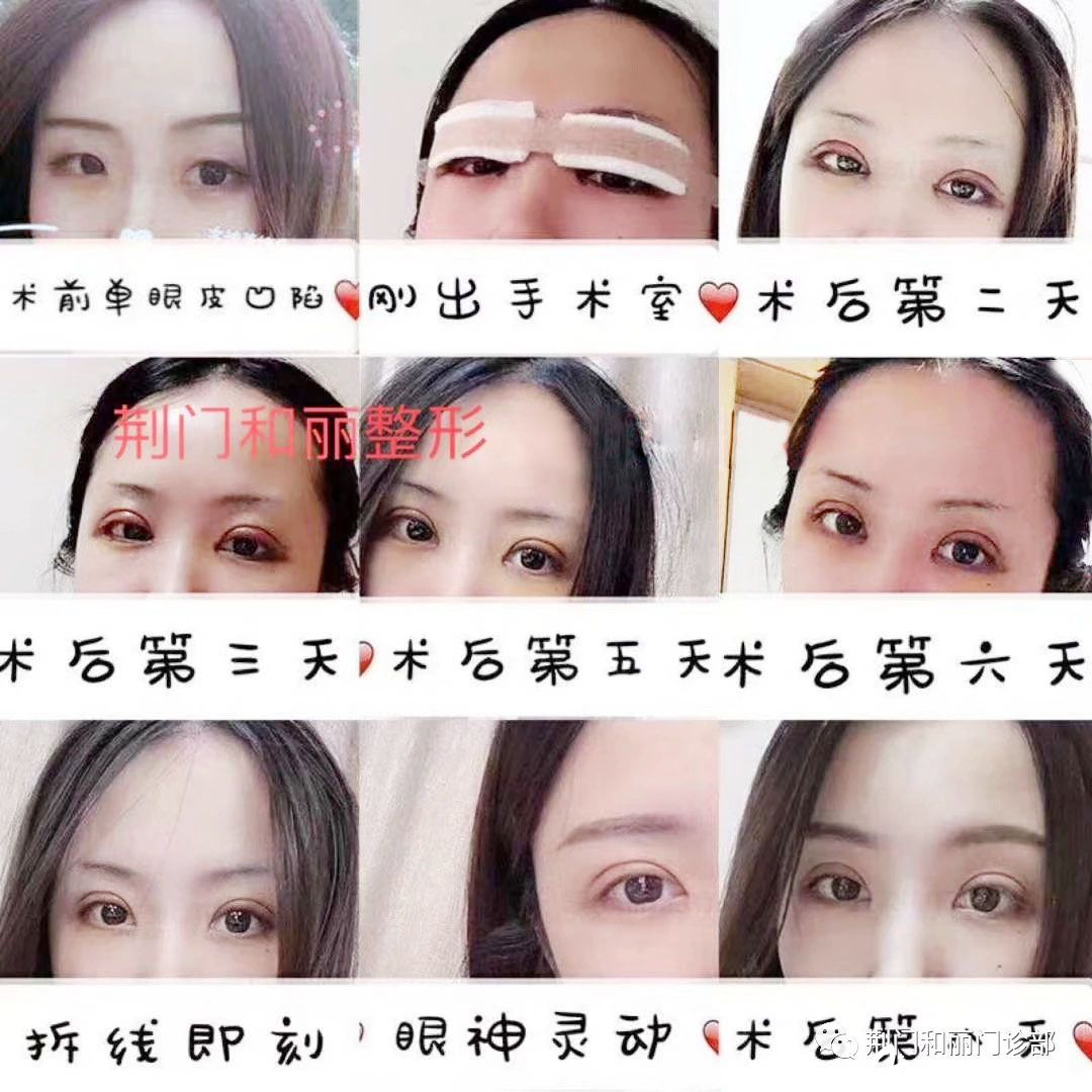 荊門和麗雙眼皮術(shù)后恢復(fù)過程圖 荊門和麗雙眼皮術(shù)后恢復(fù)過程圖
