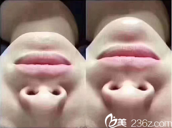 荊門和麗醫(yī)療美容玻尿酸豐下巴案例 荊門和麗醫(yī)療美容玻尿酸豐下巴案例