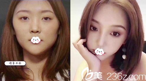 荊門和麗鼻綜合隆鼻案例效果對比圖 荊門和麗鼻綜合隆鼻案例效果對比圖