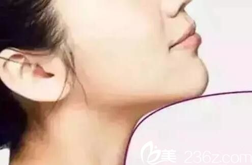 玻尿酸隆下巴多久能恢復(fù)自然？