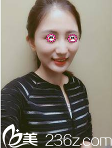 北京美萊周福田玻尿酸全面部填充案例 北京美萊周福田玻尿酸全面部填充案例