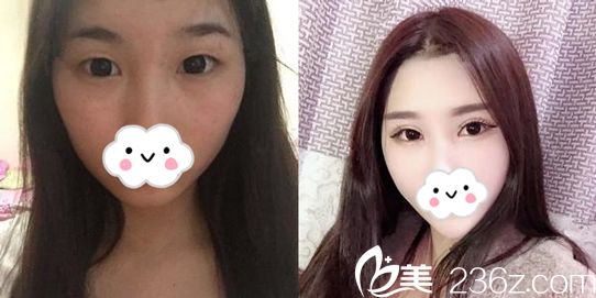 陳邦塘主任做雙眼皮手術(shù)效果案例