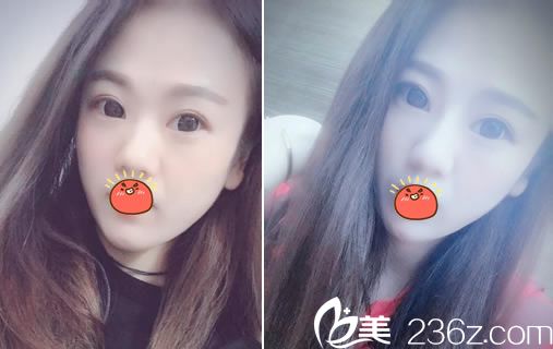 嘉興禾美<!--<i data=20240703-sp></i>-->注射玻尿酸隆鼻案例 嘉興禾美<!--<i data=20240703-sp></i>-->注射玻尿酸隆鼻案例