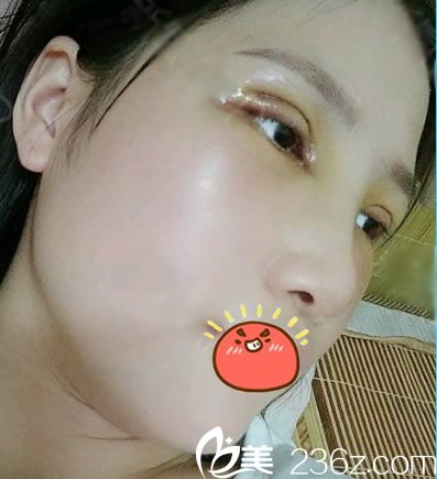 嘉興禾美做隆鼻和雙眼皮4天后