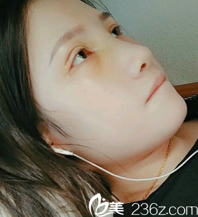做完隆鼻和雙眼皮8天恢復(fù)照