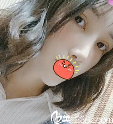 嘉興禾美趙學(xué)燕隆鼻和雙眼皮案例