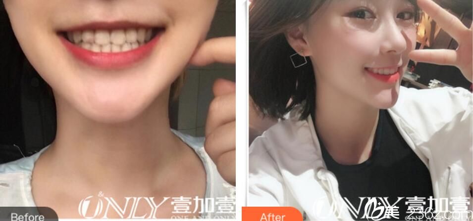 合肥壹加壹徐泓牙齒美白貼片案例 合肥壹加壹徐泓牙齒美白貼片案例