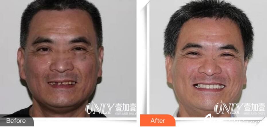 徐泓即刻種植牙即案例對比圖 徐泓即刻種植牙即案例對比圖