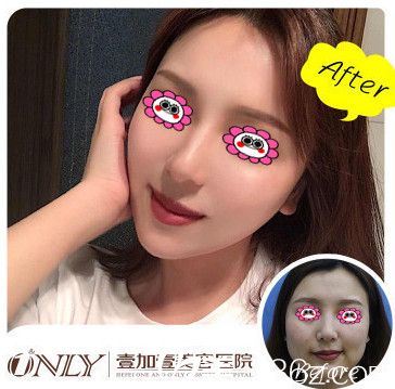 合肥壹加壹瘦臉案例圖
