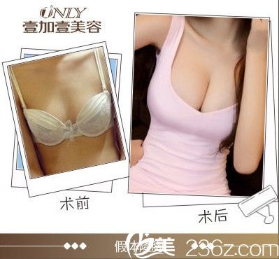 壹加壹隆胸前后對(duì)比圖